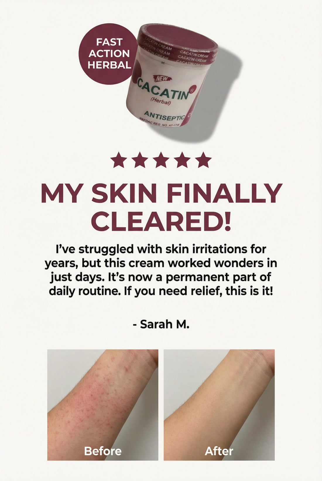 Cacatin Antiseptic Cream: Your Daily Skin-Protecting Solution for Blemishes & Irritation